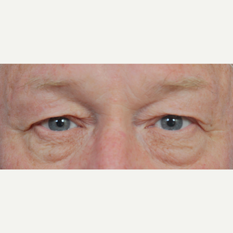 65-74 year old woman treated with Eyelid Surgery before 3441043