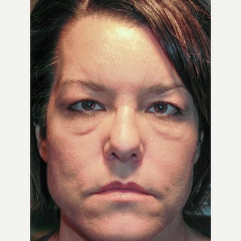 45 year old woman treated with Eye Bags Treatment by Lower lid Blepharoplasty and Festoon Treatment before 1941070
