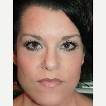 45 year old woman treated with Eye Bags Treatment by Lower lid Blepharoplasty and Festoon Treatment after 1941070