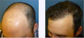 25-34 year old man treated with Hair Transplant after 3718371