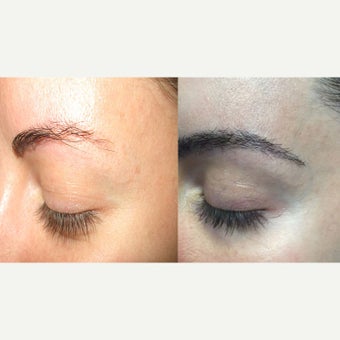 25-34 year old woman Eyebrow Transplantation before 2122703
