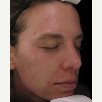 25-34 year old woman treated with Sciton CO2 Laser before 2049888