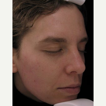 25-34 year old woman treated with Sciton CO2 Laser after 2049888
