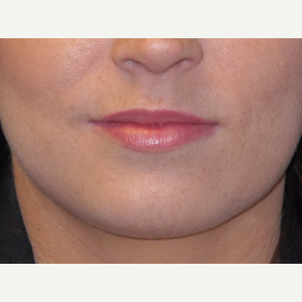 18-24 year old woman treated with Lip Augmentation after 3502361