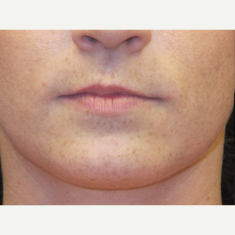 18-24 year old woman treated with Lip Augmentation before 3502361