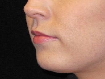 18-24 year old woman treated with Lip Augmentation 3502361