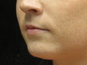 18-24 year old woman treated with Lip Augmentation 3502361