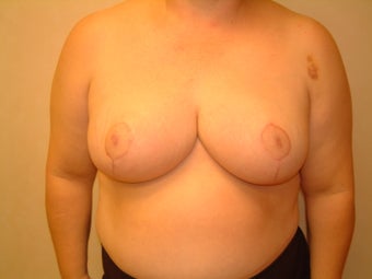 This patient is a 58 year old woman came in for a Breast Reduction after 960298