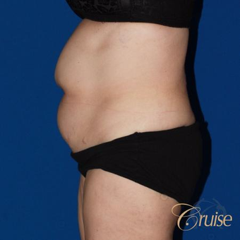 53 year old woman treated with a super extended tummy tuck before 3584879