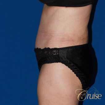 53 year old woman treated with a super extended tummy tuck after 3584879