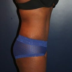 25-34 year old woman treated with Tummy Tuck after 1564526