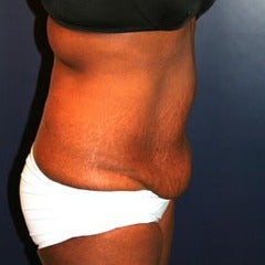 25-34 year old woman treated with Tummy Tuck before 1564526