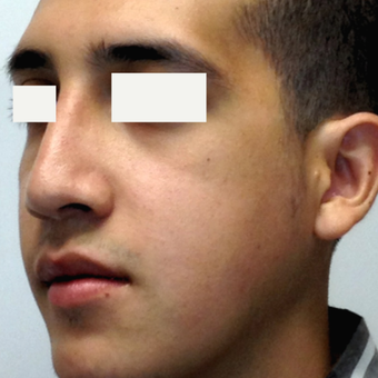 18-24 year old man treated with Orthognathic Surgery after 1615181