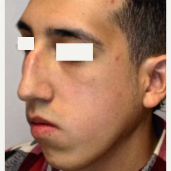 18-24 year old man treated with Orthognathic Surgery before 1615181