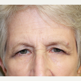 65-74 year old woman treated with Brow Lift and upper lid blepharoplasty, no lower lid work was done before 4697468