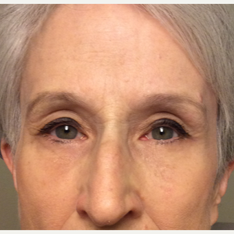65-74 year old woman treated with Brow Lift and upper lid blepharoplasty, no lower lid work was done after 4697468