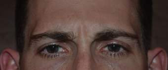 30 Year Old Male Treated for Glabellar ("11") Lines before 1380336