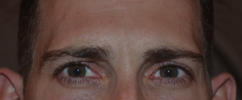 30 Year Old Male Treated for Glabellar ("11") Lines after 1380336