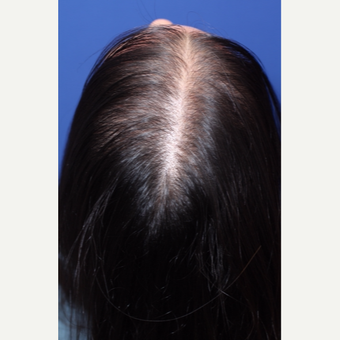Diffuse pattern hair loss in women treated by Hair Regeneration (PRP+extracellular matrix by ACell) before 2793051