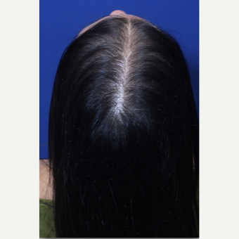 Diffuse pattern hair loss in women treated by Hair Regeneration (PRP+extracellular matrix by ACell) after 2793051