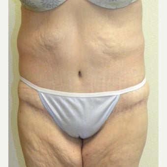 Lower Body Lift in a 36 Year-old Woman after Lap-band Surgery and Weight Loss after 1557130
