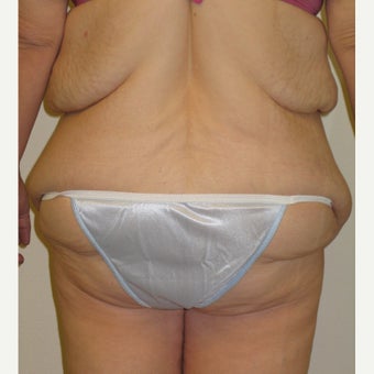 Lower Body Lift in a 36 Year-old Woman after Lap-band Surgery and Weight Loss 1557130
