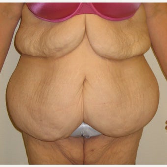 Lower Body Lift in a 36 Year-old Woman after Lap-band Surgery and Weight Loss before 1557130