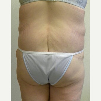 Lower Body Lift in a 36 Year-old Woman after Lap-band Surgery and Weight Loss 1557130