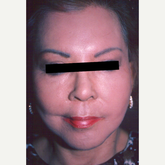65-74 year old woman treated with Chemical Peel after 3543395