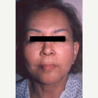 65-74 year old woman treated with Chemical Peel before 3543395