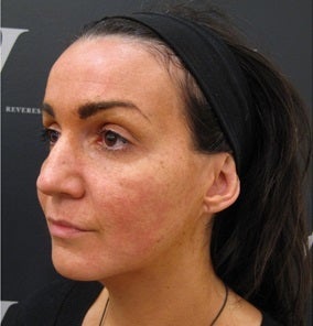Liquid facelift before 3370907