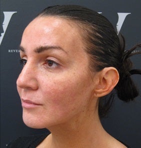 Liquid facelift after 3370907