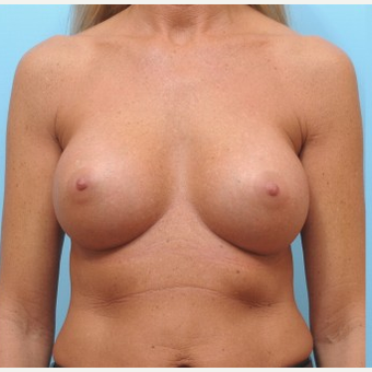 45-54 year old woman treated with Breast Augmentation after 3487380