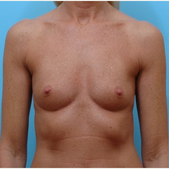45-54 year old woman treated with Breast Augmentation before 3487380