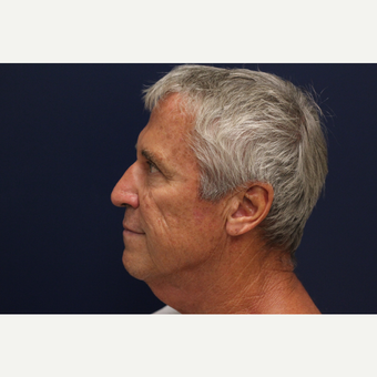 45-54 year old man treated with Smart Lipo before 3143229
