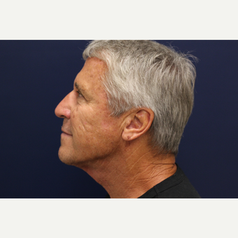 45-54 year old man treated with Smart Lipo after 3143229