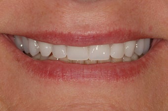 This female patiented with hopeless and missing teeth. All teeth in the top jaw were replaced with implant bridge. after 1030225