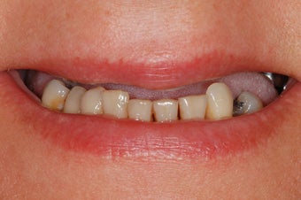 This female patiented with hopeless and missing teeth. All teeth in the top jaw were replaced with implant bridge. before 1030225