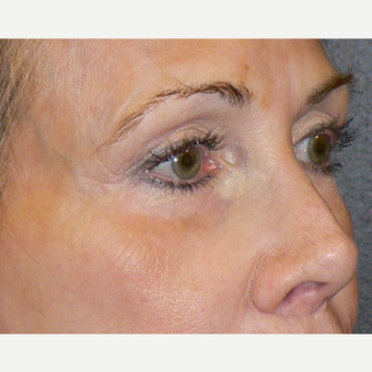 55-64 year old woman treated with Microneedling using the Venus Viva RF Microneedling treatment before 3002089