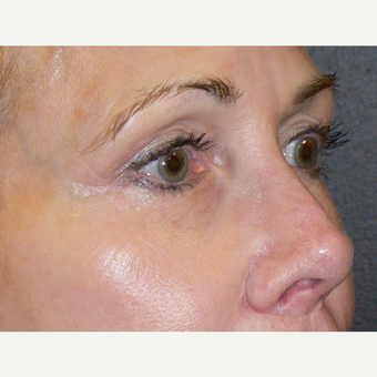 55-64 year old woman treated with Microneedling using the Venus Viva RF Microneedling treatment after 3002089