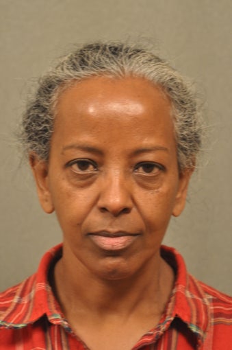 56 Year Old Female Treated for Undereye Bags before 731444