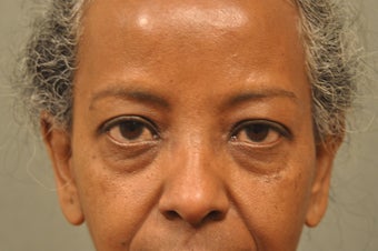 56 Year Old Female Treated for Undereye Bags 731444