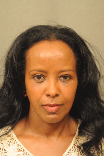 56 Year Old Female Treated for Undereye Bags after 731444
