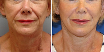 Mid Face Cheek Lift before 1360168