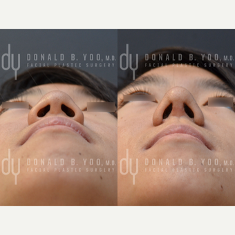Asian Rhinoplasty with Rib cartilage before 3622603