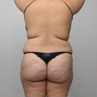 BBL, Back & Flanks Lipo, Smart Lipo, Liposculpture Body Contouring before 2396584