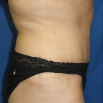 45-54 year old woman treated with Tummy Tuck after 3459216