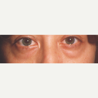35-44 year old woman treated with Eye Bags Treatment before 3545048