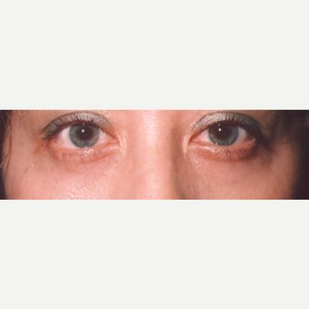 35-44 year old woman treated with Eye Bags Treatment after 3545048