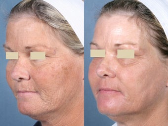 Laser Peel Treatments before 104660